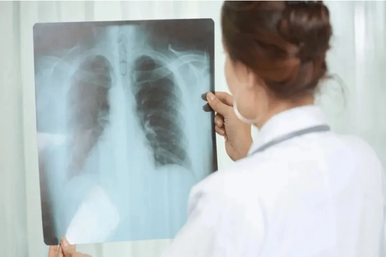 Aumento alarmante: los casos de tuberculosis en Entre Ríos se disparan un 39% en 2026